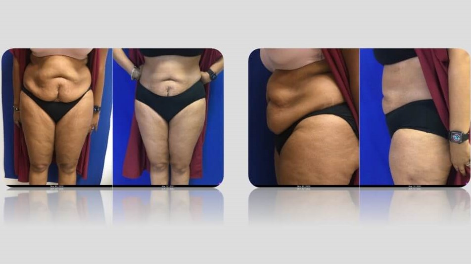Dr. Suzman Liposuction Patient